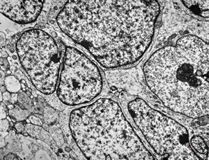 F,8y. | medulloblastoma F,8y. | medulloblastoma